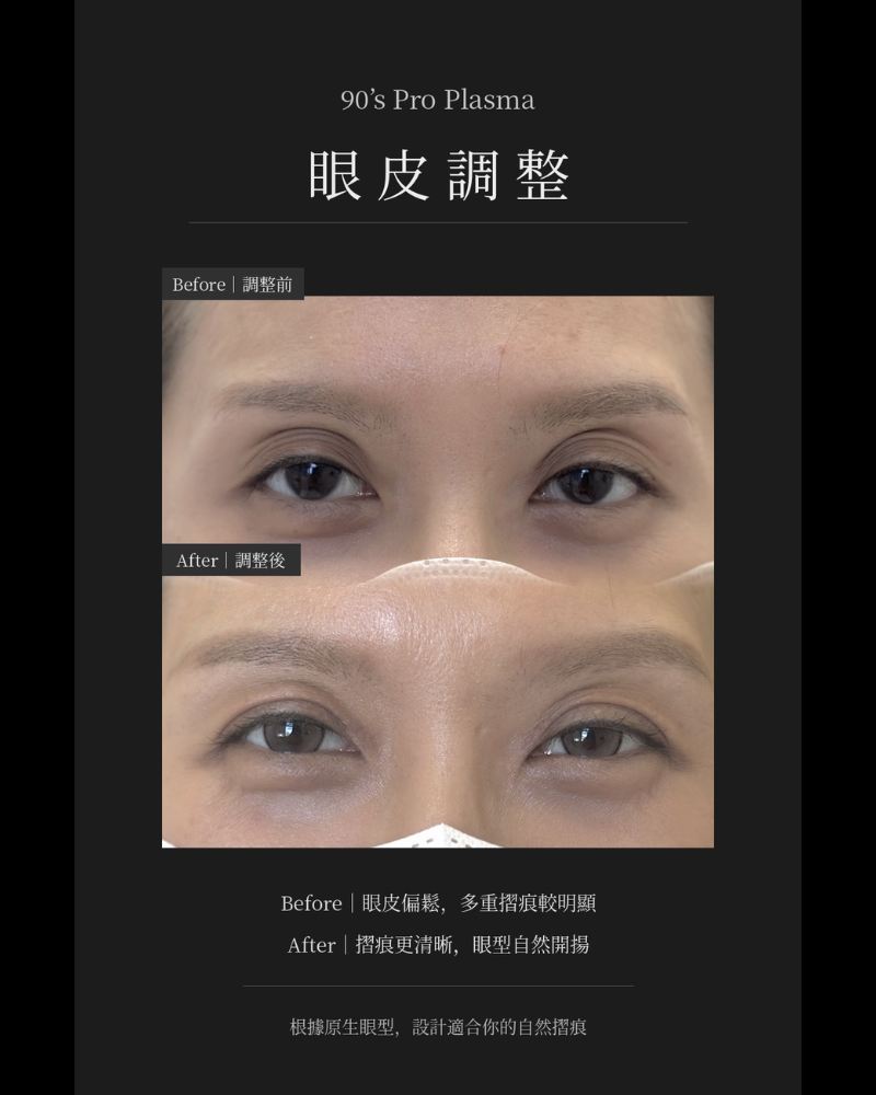 PRO PLASMA 眼瞼下垂提拉與眼周抗衰修復
