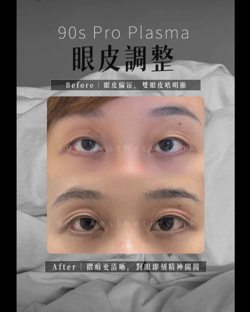 PRO PLASMA 雙眼皮修正