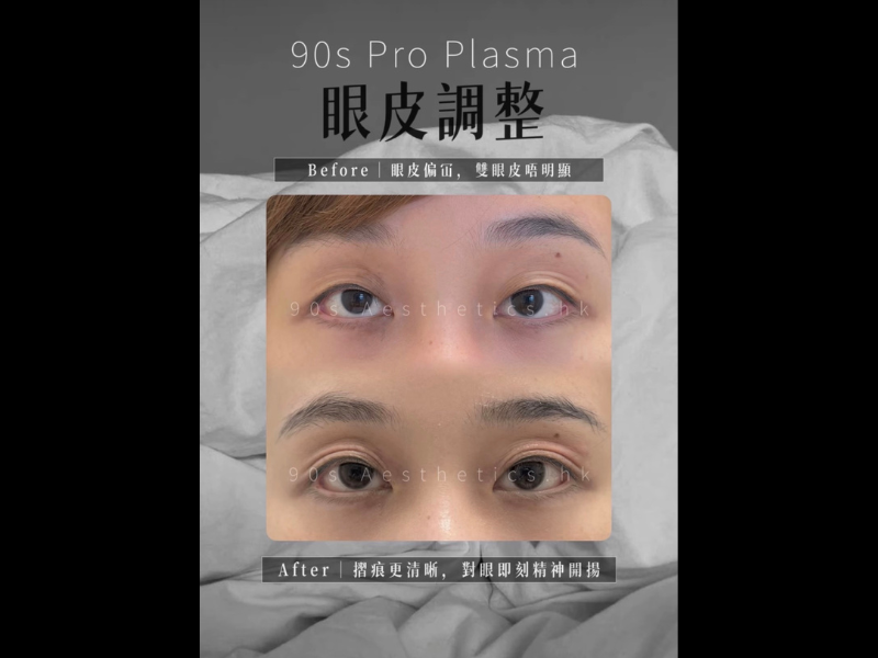 無創雙眼皮 vs 割/埋線雙眼皮：PRO PLASMA 等離子技術真的完全免開刀？原理、修復期與適合眼型全解析