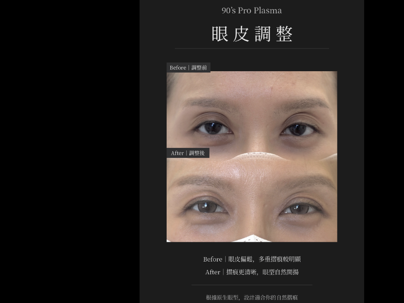 PRO PLASMA 雙眼皮修正