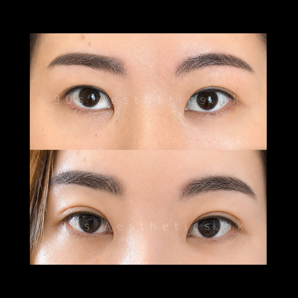 PRO PLASMA 無創雙眼皮修正｜自然隱形摺痕與眼皮提拉
